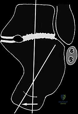 إصلاح الأوتار الشظوية المتضررة