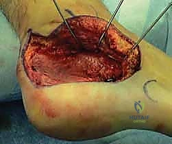 تمارين الحركة اللطيفة في المرحلة الثانية