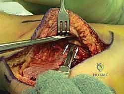 صورة طبية: إتقان إعادة بناء سوء التئام عظم الكعب: دليل شامل للمرضى مع الأستاذ الدكتور محمد هطيف