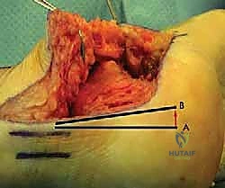 التحميل التدريجي للوزن والعلاج الطبيعي المكثف