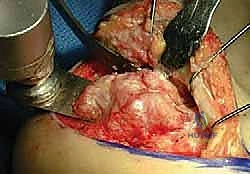 صورة توضيحية لـ إتقان إعادة بناء سوء التئام عظم الكعب: دليل شامل للمرضى مع الأستاذ الدكتور محمد هطيف