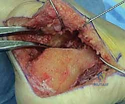 الأستاذ الدكتور محمد هطيف أثناء
![صورة طبية: إتقان إعادة بناء سوء التئام عظم الكعب: دليل شامل للمرضى مع الأستاذ الدكتور محمد هطيف