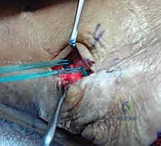 صورة توضيحية لـ إتقان إعادة بناء سوء التئام عظم الكعب: دليل شامل للمرضى مع الأستاذ الدكتور محمد هطيف