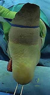 إزالة النتوءات العظمية الجانبية