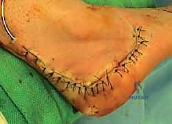 صورة توضيحية لـ إتقان إعادة بناء سوء التئام عظم الكعب: دليل شامل للمرضى مع الأستاذ الدكتور محمد هطيف