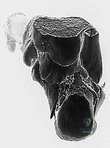 انحشار العصب