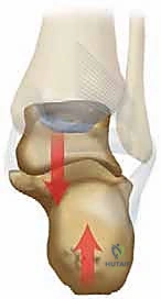 صورة بالأشعة المقطعية لكسر عظم العقب