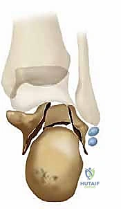 صورة طبية: جراحة تصحيح سوء التئام عظم العقب وتثبيت المفصل تحت الكاحل في صنعاء