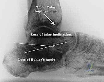 الانحشار الشظوي العقباني