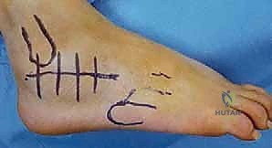 جراحة تصحيح سوء التئام عظم العقب وتثبيت المفصل تحت الكاحل في صنعاء