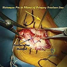 صورة طبية: جراحة تصحيح سوء التئام عظم العقب وتثبيت المفصل تحت الكاحل في صنعاء