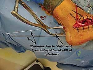 صورة توضيحية لـ جراحة تصحيح سوء التئام عظم العقب وتثبيت المفصل تحت الكاحل في صنعاء