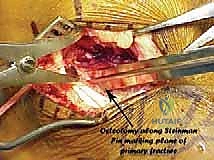 صورة طبية: جراحة تصحيح سوء التئام عظم العقب وتثبيت المفصل تحت الكاحل في صنعاء