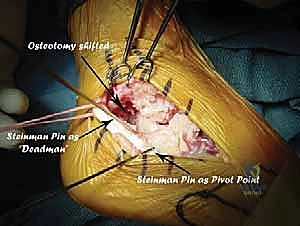 صورة طبية: جراحة تصحيح سوء التئام عظم العقب وتثبيت المفصل تحت الكاحل في صنعاء