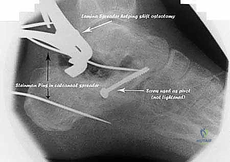 صورة توضيحية لـ جراحة تصحيح سوء التئام عظم العقب وتثبيت المفصل تحت الكاحل في صنعاء