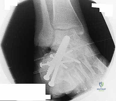 صورة طبية: جراحة تصحيح سوء التئام عظم العقب وتثبيت المفصل تحت الكاحل في صنعاء