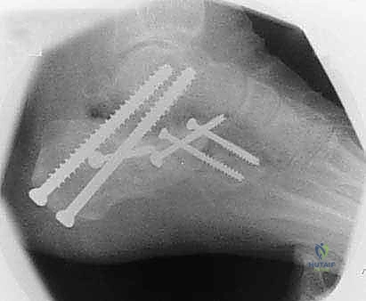 صورة طبية: جراحة تصحيح سوء التئام عظم العقب وتثبيت المفصل تحت الكاحل في صنعاء
