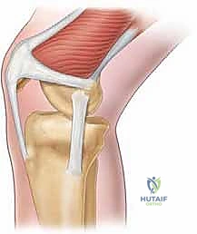 Proximal Realignment: Masterclass in Medial Patellofemoral Ligament Repair