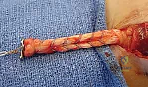 Distal Biceps Tendon Repair & Reconstruction: An Intraoperative Masterclass