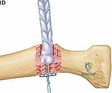 التقنيات الجراحية المتقدمة لإصلاح وتر العضلة ذات الرأسين البعيد