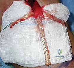 إصلاح وإعادة بناء وتر العضلة ذات الرأسين البعيد: دليلك الشامل لنتائج ممتازة مع الأستاذ الدكتور محمد هطيف