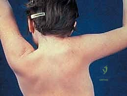 Illustration of elevation of the scapula - Dr. Mohammed Hutaif