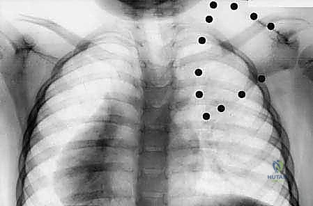 استئصال العظم الكتفي الفقري لتحرير لوح الكتف