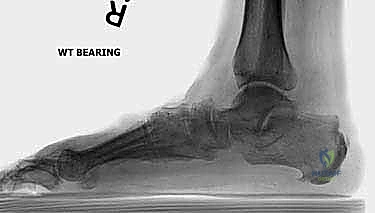 الأشعة السينية قبل وبعد تثبيت القدم الثلاثي
