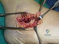 تأثير التهاب المفاصل على غضاريف القدم