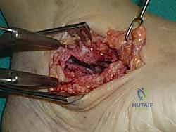 إدخال المسامير المعدنية لتثبيت المفاصل