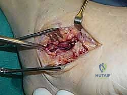 الفحص السريري للقدم الخلفية