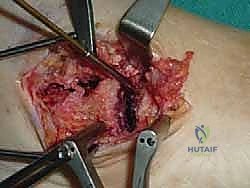 صورة طبية: تثبيت مفصل القدم الثلاثي في صنعاء دليل شامل لاستعادة حركة القدم وتخفيف الألم مع الأستاذ الدكتور محمد هطيف