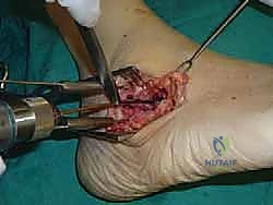 تثبيت مفصل القدم الثلاثي في صنعاء دليل شامل لاستعادة حركة القدم وتخفيف الألم مع الأستاذ الدكتور محمد هطيف