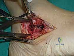 توجيه المسامير باستخدام الأشعة داخل العمليات