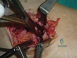 صورة توضيحية لـ تثبيت مفصل القدم الثلاثي في صنعاء دليل شامل لاستعادة حركة القدم وتخفيف الألم مع الأستاذ الدكتور محمد هطيف