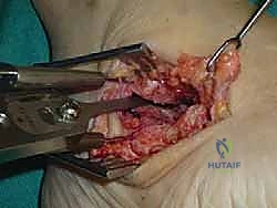 إزالة الغضاريف التالفة وتحضير العظم