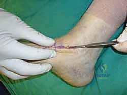 استخدام الدعامات كعلاج تحفظي مبدئي