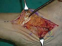 الدكتور محمد هطيف أثناء التخطيط الجراحي