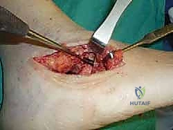 تعديل وضعية العظام وتصحيح التشوه