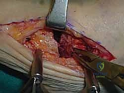 صورة طبية: تثبيت مفصل القدم الثلاثي في صنعاء دليل شامل لاستعادة حركة القدم وتخفيف الألم مع الأستاذ الدكتور محمد هطيف