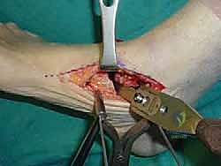 صورة طبية: تثبيت مفصل القدم الثلاثي في صنعاء دليل شامل لاستعادة حركة القدم وتخفيف الألم مع الأستاذ الدكتور محمد هطيف