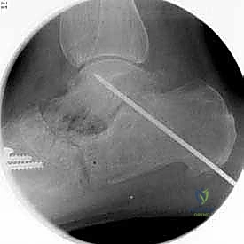 صورة توضيحية لـ تثبيت مفصل القدم الثلاثي في صنعاء دليل شامل لاستعادة حركة القدم وتخفيف الألم مع الأستاذ الدكتور محمد هطيف