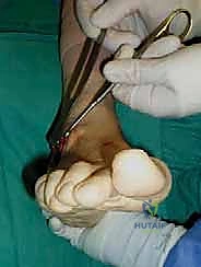 صورة توضيحية لـ تثبيت مفصل القدم الثلاثي في صنعاء دليل شامل لاستعادة حركة القدم وتخفيف الألم مع الأستاذ الدكتور محمد هطيف