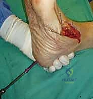 صورة توضيحية لـ تثبيت مفصل القدم الثلاثي في صنعاء دليل شامل لاستعادة حركة القدم وتخفيف الألم مع الأستاذ الدكتور محمد هطيف