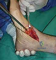 صورة طبية: تثبيت مفصل القدم الثلاثي في صنعاء دليل شامل لاستعادة حركة القدم وتخفيف الألم مع الأستاذ الدكتور محمد هطيف