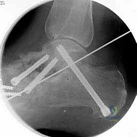 التثبيت النهائي بالمسامير والشرائح