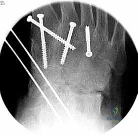 صورة توضيحية لـ تثبيت مفصل القدم الثلاثي في صنعاء دليل شامل لاستعادة حركة القدم وتخفيف الألم مع الأستاذ الدكتور محمد هطيف
