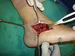 صورة طبية: تثبيت مفصل القدم الثلاثي في صنعاء دليل شامل لاستعادة حركة القدم وتخفيف الألم مع الأستاذ الدكتور محمد هطيف