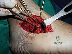 بدء العلاج الطبيعي والتحميل التدريجي