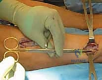 OITE & ABOS Orthopedic Board Prep: Practice Exam Part 64